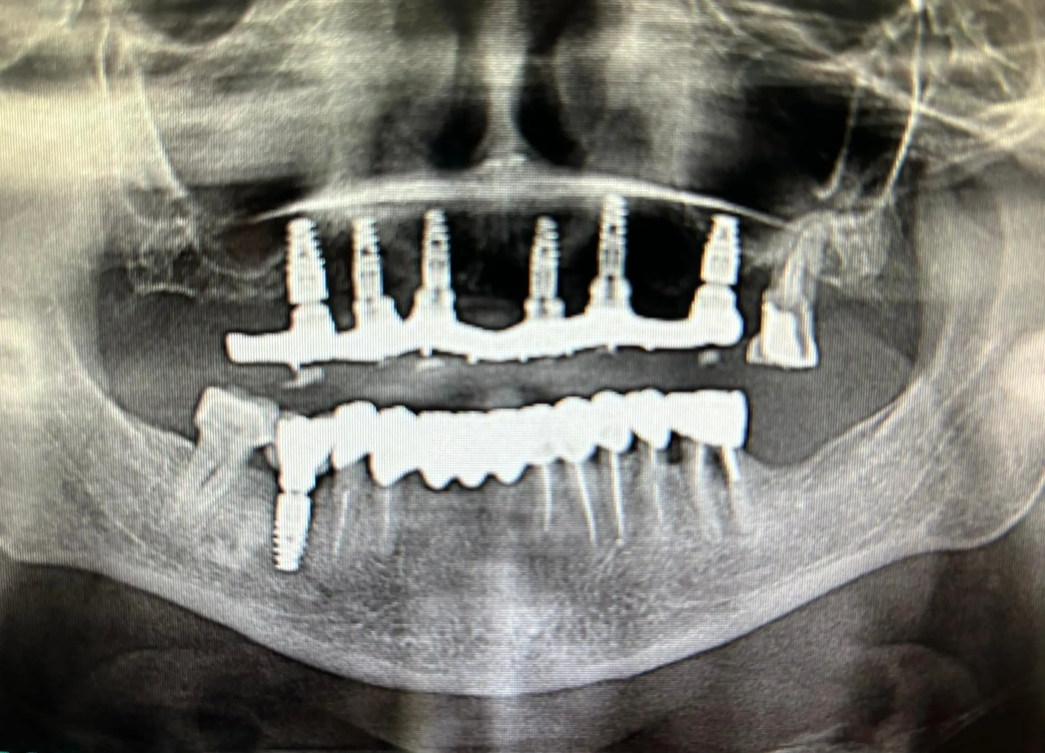 Chirurgie pré-implantaire
