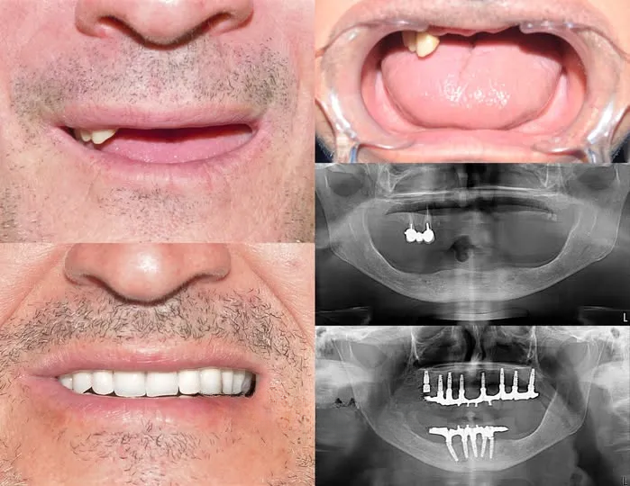 All-on-6 réhabilitation complète