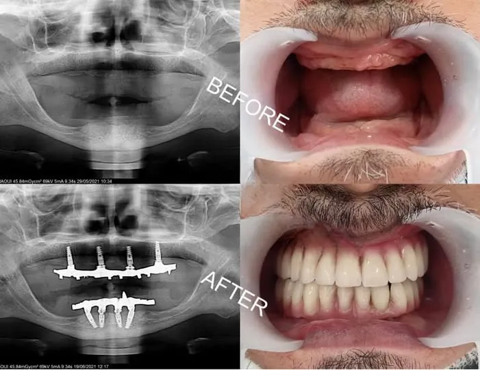 All-on-8 solution ultra-robuste