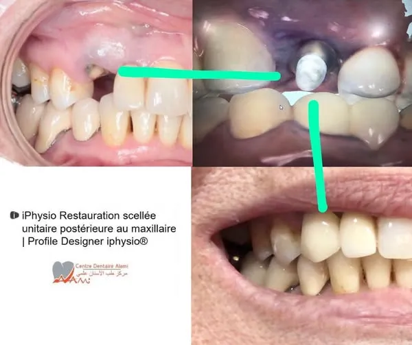 Implant unitaire premium