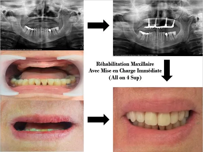 Mise en charge immédiate