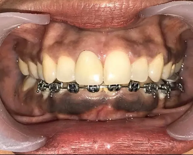 Appareils céramiques discrets